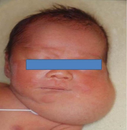 新生兒左臉頰長淋巴管瘤